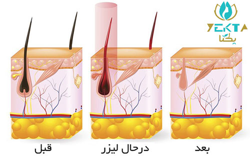 لیزر موهای زائد - کلینیک زیبایی یکتا لیزر موهای زائد - کلینیک زیبایی یکتا