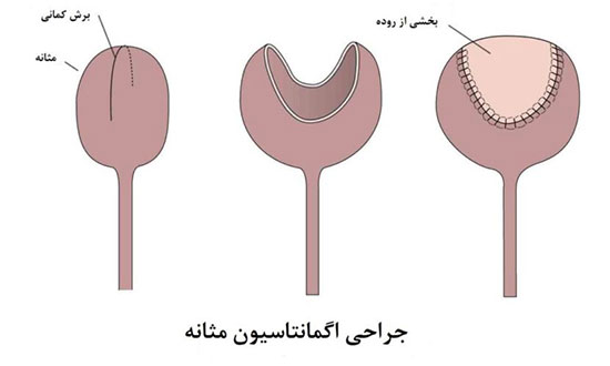 سیستیت بینابینی یا سندرم مثانه دردناک (IC)؛ علتها، علائم و درمان