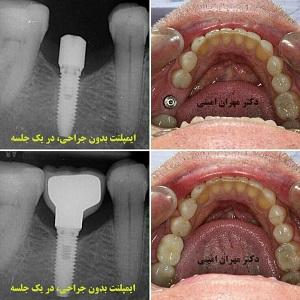 قيمت ايمپلنت - دکتر مهران امینی