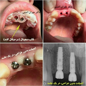 قيمت ايمپلنت - دکتر مهران امینی