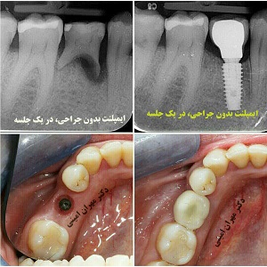 قيمت ايمپلنت - دکتر مهران امینی