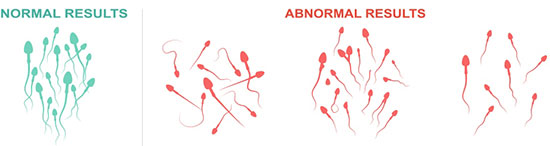 ۱۶ مورد در آزمایش اسپرم و تفسیر آنلاین آن