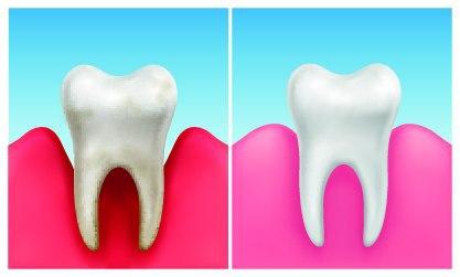 مراقب این بیماری شایع لثه باشید