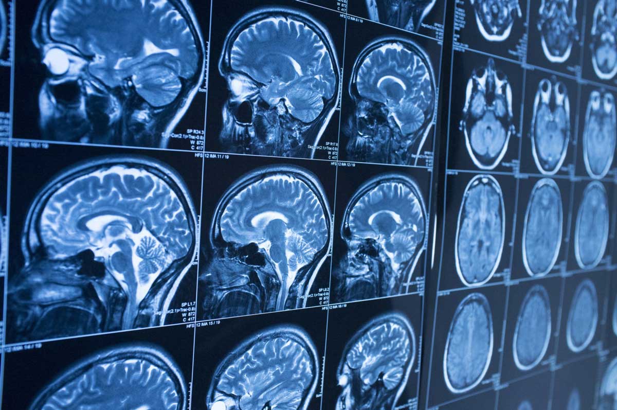 تشخیص آلزایمر با هوش مصنوعی ۱۰ سال زودتر