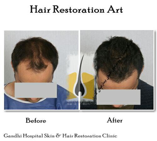 کاشت مو – اطلاعاتی ضروری که باید در مورد جراحی کاشت مو از آن آگاهی داشته باشید