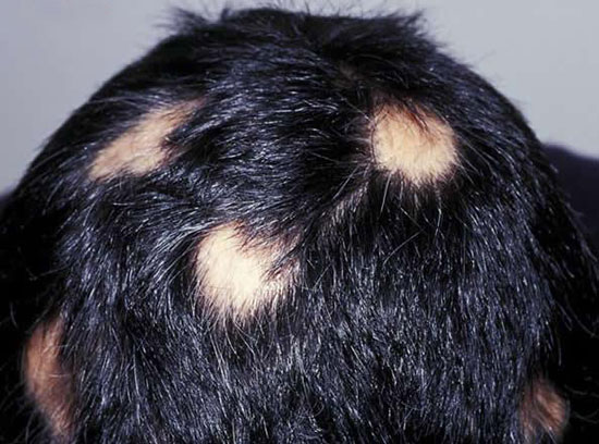 «ریزش موی سکه‌ ای» از تشخیص تا درمان