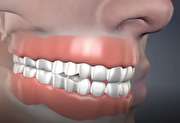 پیامدهای مخرب از دست دادن دندان (+فیلم)