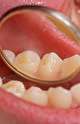 نشانه‌های هشداردهنده اولیه سرطان دهان