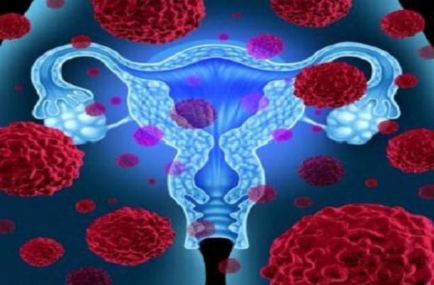هر آنچه که زنان باید در مورد سرطان تخمدان بدانند