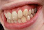 چرا روی دندان، لکه‌های سفید شکل می‌گیرد؟ (فیلم)