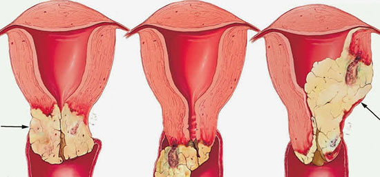 سرطان واژن زنان، همه آنچه باید بدانید