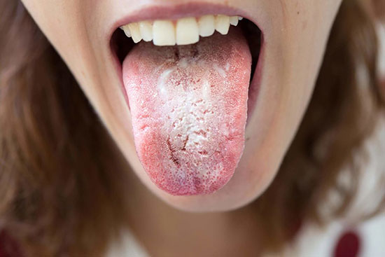 برفک دهان چیست؟ علائم و راه‌های درمان آن را بشناسید