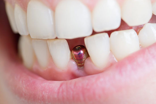 ایمپلنت دندان‌های قدامی و مشکلات کشیدن زود‌رس دندان‌ها