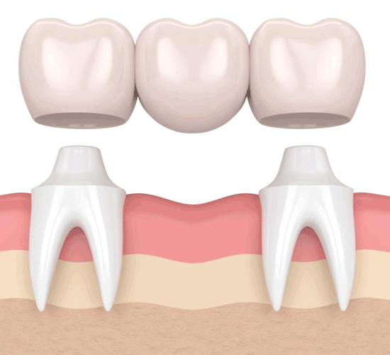 بریج دندان چیست؟ انواع، مزایا و معایب بریج دندان