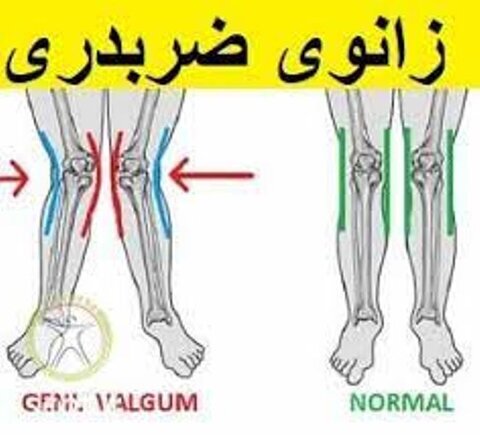 ۴ ورزش ویژه برای زانوی ضربدری کودکان